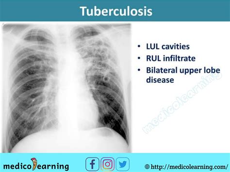 Tuberculosis X Ray