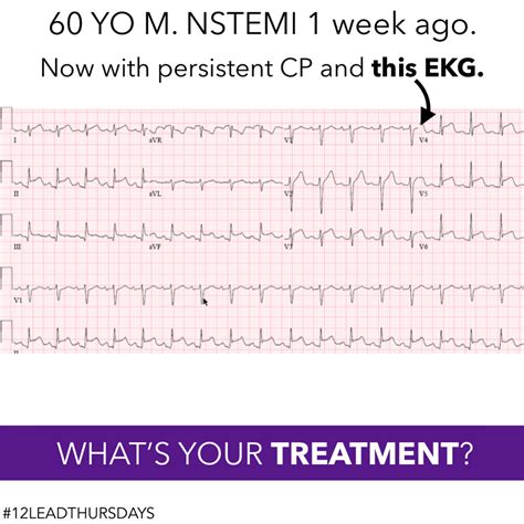 Nstemi Ecg : : The standard 12 lead electrocardiogram (ecg) has several limitations.
