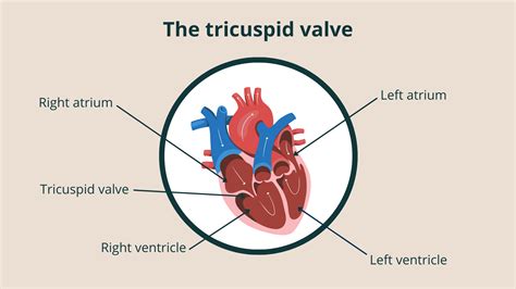 Tricuspid regurgitation - Guys and St Thomas Specialist Care