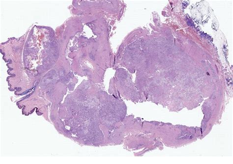 Dermatopathology Society of India: Image of the Month