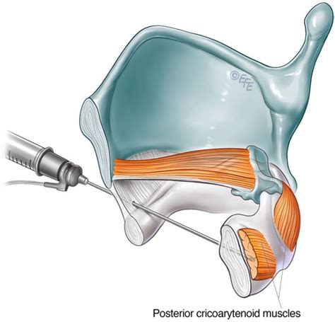 Posterior Cricoarytenoid Muscle
