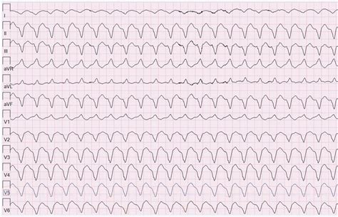 Wide Complex Tachycardias - Emergency Medicine Clinics