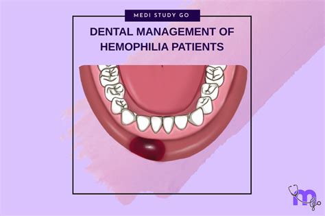 Dental Management of Hemophilia Patients: Evidence-Based Protocols ...