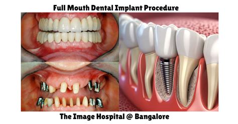 Tooth Implants Procedure 的图像结果