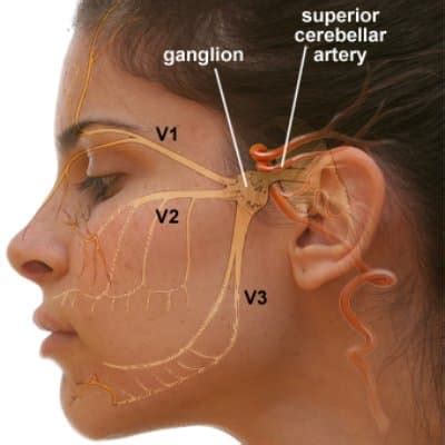 Image result for Microvascular Decompression Surgery