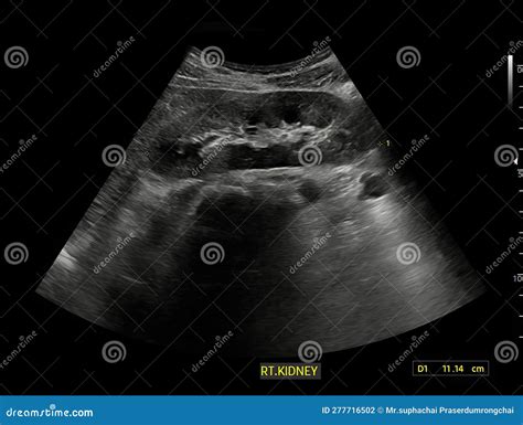 Kidney Stone Ultrasound