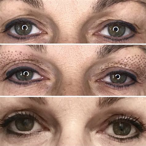 Plasma Revive - Eye Lift & Skin Tightening without surgery