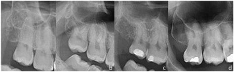 Panoramic Radiography vs. CBCT in the Evaluation of the Maxillary Third ...
