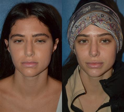 Celebrity Septoplasty Before And After