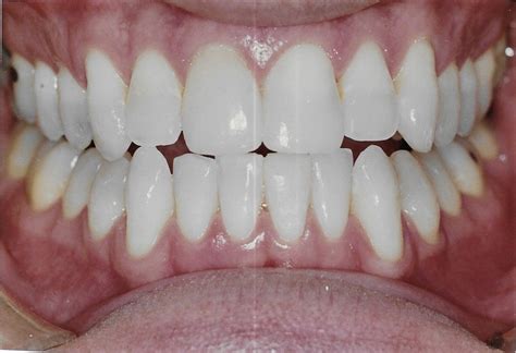 Image result for Bioclear Matrix System