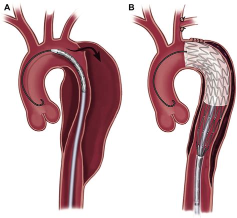 Type B Aortic Dissections - Cardiology Clinics