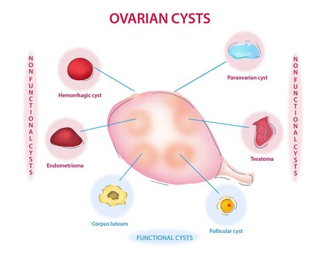 Cystic Follicle And Follicular Cyst