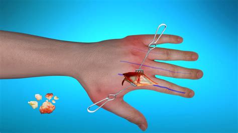 Surgical Treatment for Rheumatoid Arthritis of Hands - YouTube