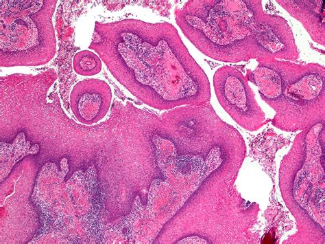 Oral Epidermoid Carcinoma