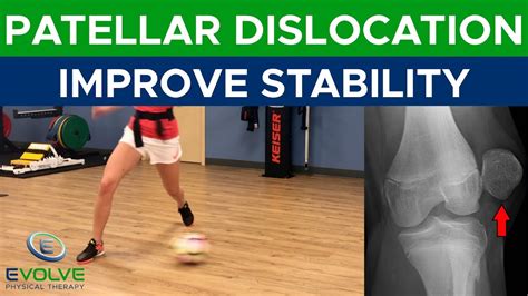 Image result for Patellar Dislocation Exercises
