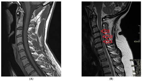 What Is A Mri Cervical Spine Without Contrast at Brayden Woodd blog