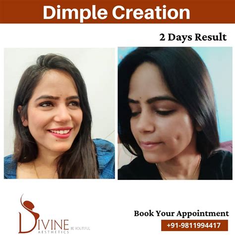 Dimple Surgery Dimple Creation Surgery/ Dimpleplasty