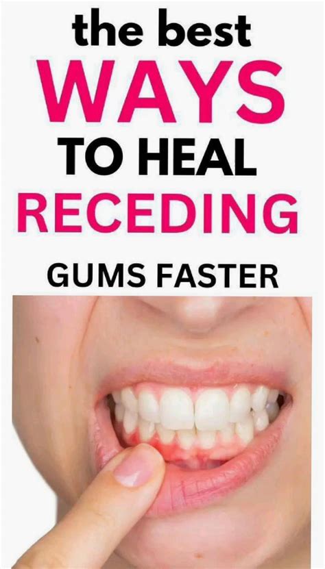Top Tips for Quick Gum Healing in 2024: Restore Receding Gums and ...