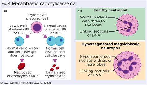 Understanding the causes, symptoms and treatments of anaemias | Nursing ...