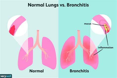 Symptome einer Bronchitis - MedDe