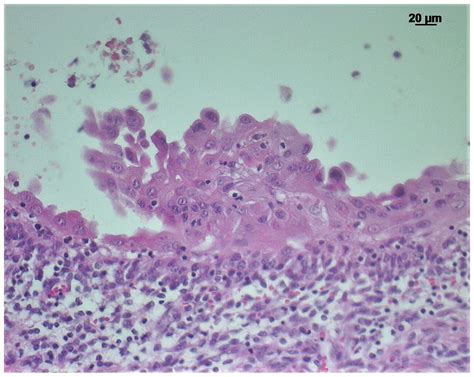Spindle Cell Tumor In Dogs Mouth