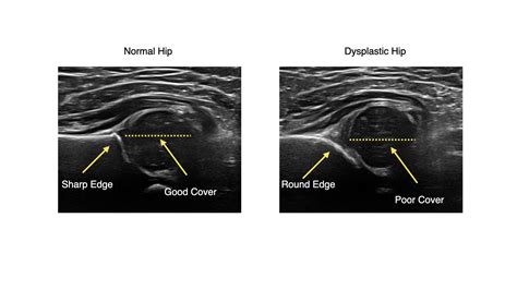Baby Hip Dysplasia Ultrasound at Damian Goad blog