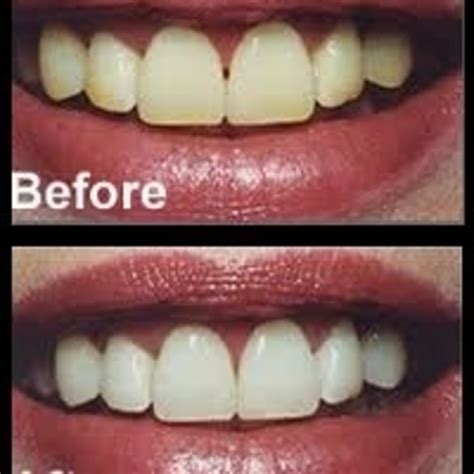 Image result for Baking Powder Toothpaste Hack