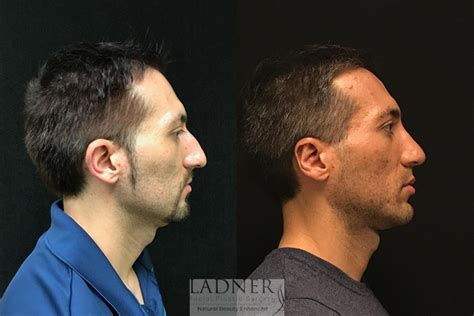 Facial Plastic Surgery for Men Before and After Pictures Case 18 | Denver, CO | Ladner Facial ...