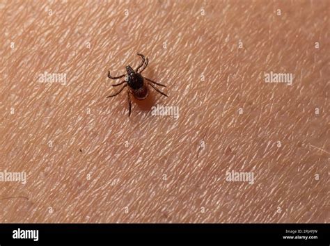 Image result for Embedded Deer Tick