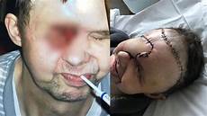 trou peau visage homme on lui diagnostique une migraine il a un cancer fulgurant trou peau visage homme on lui diagnostique une migraine il a un cancer fulgurant