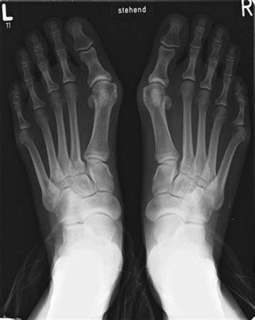 Hallux Valgus - Foot & Ankle - Orthobullets