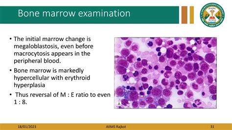 Macrocytic Anemia.pptx