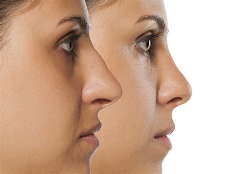 Rinoplastika, rekonstruktivna hirurgija nosa | Zdravlje i prevencija ...