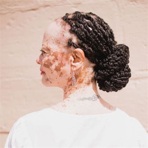 5 Types of Vitiligo and What They Mean | Living Dappled