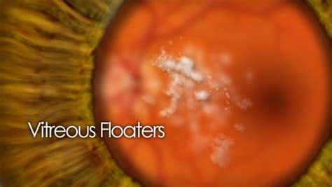 Image result for Eye Floaters Under Microscope