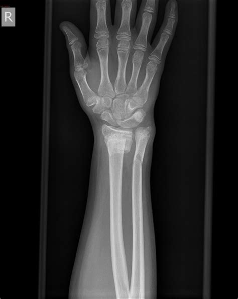 Xray Hand Bones