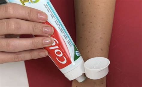 Toothpaste On Dark Spots 的图像结果