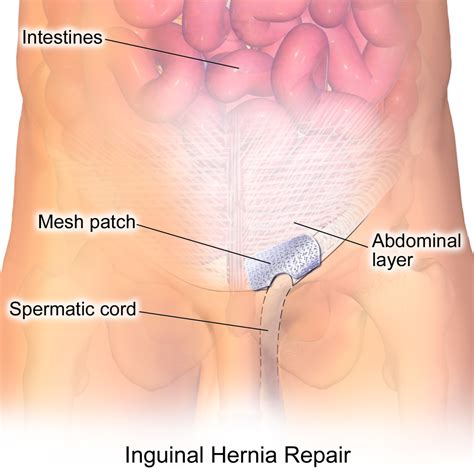 Tips for Recovery From an Inguinal Hernia Surgery - Patient's Lounge