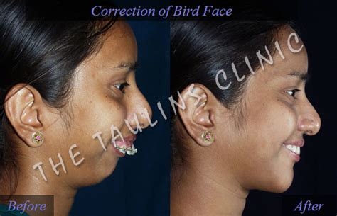 Bird Face/ Fish Mouth Correction Bangalore, INDIA