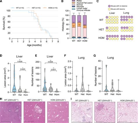 Palmitoyl transferase ZDHHC20 promotes pancreatic cancer metastasis: Cell Reports