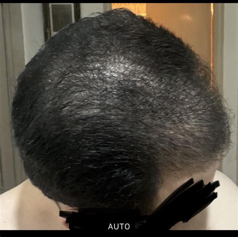 Two months of 5% Min (once a day), month-and-a-half of 2% Keto : r ...