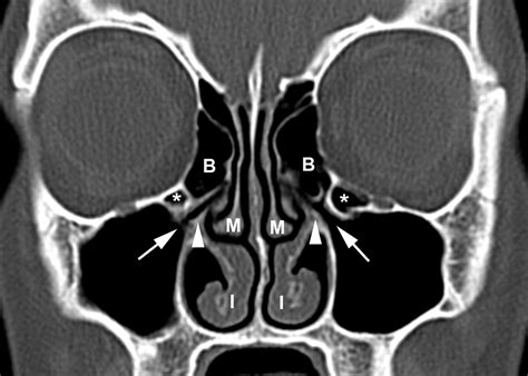 Sphenoid Sinus Mri