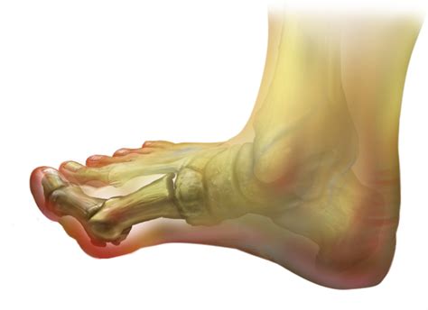 Bunions – Central Virginia Foot & Ankle Laser Center
