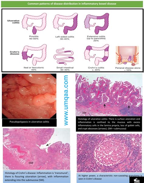 What are the differences between Crohn's disease (CD) and Ulcerative ...