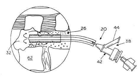 Extradural Infusion Suction System and Method to Drain Fluid Collection in the Extradural Space ...
