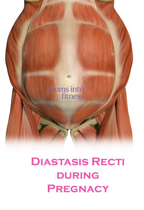 Diastsis Recti - A Guide to Separated Abdominal Muscles | Moms Into Fitness | Diastasis recti ...