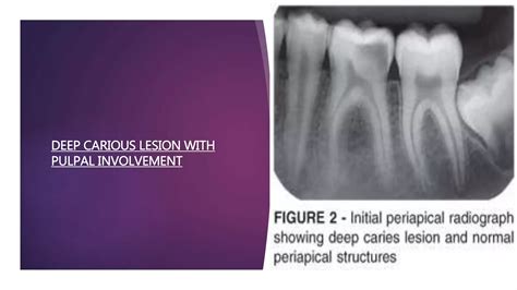 Image result for Difference Between Direct and Indirect Pulp Capping