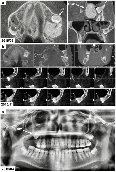 Combined Surgical and Orthodontic Treatment of Complex Odontoma in ...