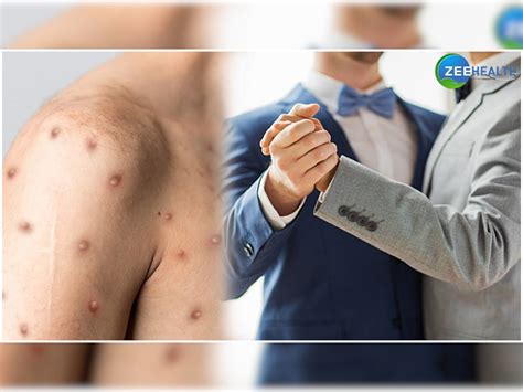 gay man revealed his suffering from monkeypox virus infection know his ...