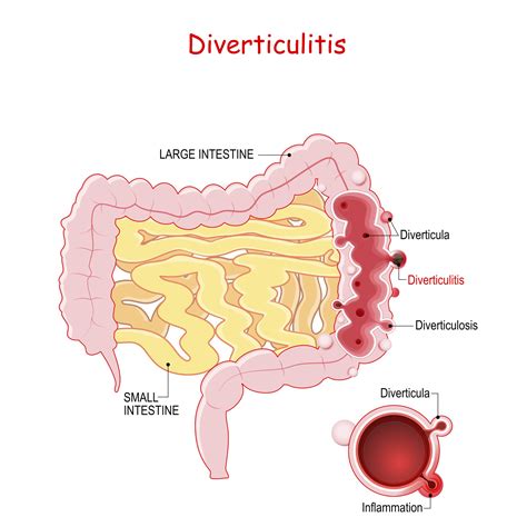 Diagnosis And Management Of Acute Diverticulitis